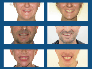 Le collage harmonique en Bretagne