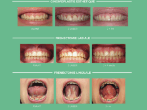 Le laser au cabinet d’orthodontie en Bretagne