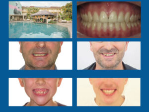 Le sourire idéal : Personnalisez le placement des brackets pour sublimer vos traitements en Martinique