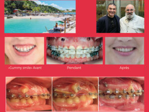 Pose des vis d’ancrage par l’orthodontiste : Pour quoi faire ? Comment faire ? en Guadeloupe