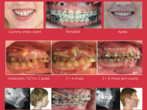 Pose des vis d’ancrage par l’orthodontiste : Pour quoi faire ? Comment faire ? en Bretagne